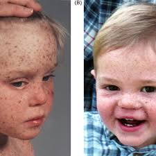 Symptoms begin in early childhood. Xeroderma Pigmentosum Patients With And Without Neurological Disease Download Scientific Diagram