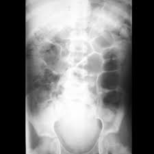 Image result for Pediatric Constipation