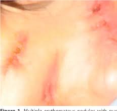 The combination of tuberculosis cutis lichenoides and tuberculosis cutis colliquativa (scrofuloderma) kushtan i.v.1, grabovskaya o.v.2, teplyuk n.p.2, varshavskiy v.a.2, grishina v.b.2. A Case Of Tuberculosis Cutis Colliquativa Treated With Rifampicin And Isoniazid Semantic Scholar