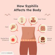 Image result for syphilis symptoms