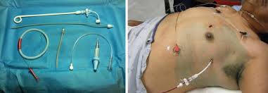 Image result for Small Caliber Chest Tube