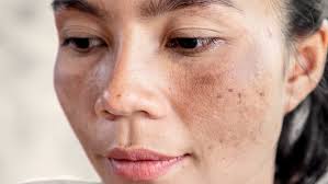 Image result for Melasma
