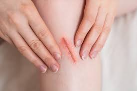 In skin and wound care •legal consultant •former npuap board member 3. How To Treat Different Types Of Cuts Grazes And Gashes Aero Health Care