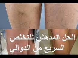 ما هى دوالى الساقين ؟! Ø¹Ù„Ø§Ø¬ Ø§Ù„Ø¯ÙˆØ§Ù„ÙŠ Ø¨Ø§Ù„Ø§Ø¹Ø´Ø§Ø¨
