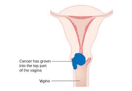 Cervical cancer is cancer that begins in the uterine cervix, the lower end of the uterus that contacts the upper vagina. Cervical Cancer Treatment Cost In India Cervical Cancer Treatment In India