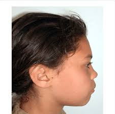 A: Profile view of patient #1showing lip protrusion and convex profile.
