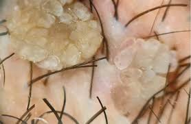 Vestibular Papillomatosis Explained! - Youtube
