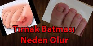 Tirnak Batmasi Ameliyati Tirnak Batmasi Tirnak Tirnak