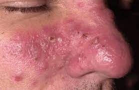 Es ist wichtig, die art der akne zu identifizieren, an der sie leiden, da jede art unterschiedlich ist und eine andere behandlung erfordert. Rosacea Skin Disorders Merck Manuals Consumer Version