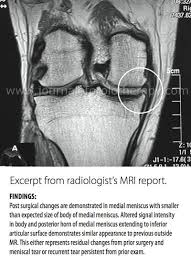 Knee pain may be the result of an injury, such as a ruptured ligament or torn cartilage. The Evidence For Non Surgical Bucket Handle Meniscus Tear Repair Caring Medical Florida