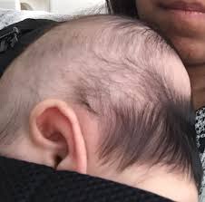 If your baby is still losing a lot of hair after he's six months old, talk to your gp. Baby Hair Loss April 2015 Babies Forums What To Expect