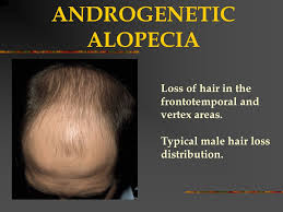 Hair loss, also known as alopecia or baldness, refers to a loss of hair from part of the head or body. Illnesses That Cause Hair Loss Hair Regrowth Treatment Clinic In Lahore