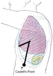 A positive murphy sign can be seen with acute cholecystitis. Castell S Sign Wikipedia