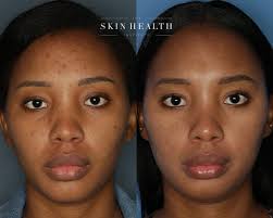 Start the new year with a brighter, smoother, clearer complexion ✨ With our  approach you're guaranteed to achieve your best skin yet 👏🏽 The results  speak for themselves! Not sure how to