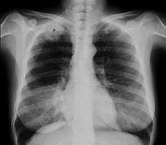 The lung cancer mortality in females in the usa and. Pancoast Tumor Wikipedia