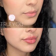 Patient naturally has a voluminous bottom lip. Hence, we focused more