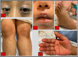 Image result for Multisystem Inflammatory Syndrome