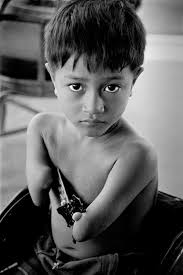 Agent Orange: Collateral Damage in Vietnam • Philip Jones Griffiths •  Magnum Photos
