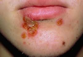 Wenn eine erkrankung der atemwege wird durch rote, geschwollene oder schmerzhaften haut begleitet, ist sein ursprung wahrscheinlich mrsa. Kutane Infektionen Durch Staphylokokken Und Streptokokken Springerlink