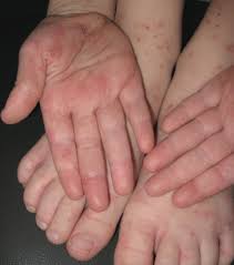Image result for human scabies