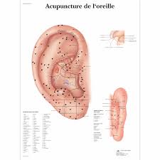 Acupuncture De Loreille