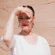 Image result for Vitiligo