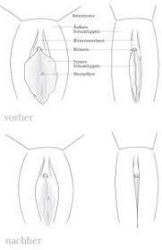 Ob die krankenkasse den eingriff übernimmt ist abhängig von den. Schamlippenkorrektur Enzyklopaedia Aesthetica