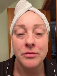 Any advice for treating dry skin and rash?