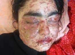 Stevens Johnson Syndrome Sjs Causes Symptoms Treatment