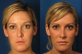 Related Image Cheek Fillers Cheek Skin