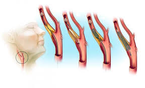 Stenoz Sonnyh Arterij Chto Eto Takoe Simptomy Prichiny Diagnostika Lechenie Prognoz I Profilaktika