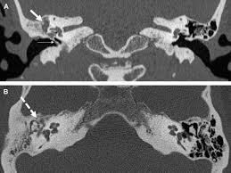 Image result for Myringosclerosis