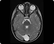 Arachnoid Cyst