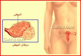 سرطان المبيض Ovarian Cancer