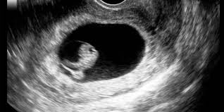 Also bei den zwillingen war ich das erste mal bei 8+2 beim arzt und da sah man was. Ultraschall Einfach Erklart Im Grossen Ziam Ratgeber Fur Patienten