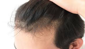 Imgur user geniusesgoingwheee, whose real name is samantha, suffers from alopecia areata, which is a disease that results in patchy areas on the scalp. Spotlight On Biofibre Aesthetics