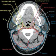 The erector spinae group is the intermediate layer of the intrinsic muscles of the back. Nontraumatic Head And Neck Emergencies Radiographics