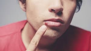 Lippenherpes ist eine häufig vorkommende, sehr ansteckende krankheit. Herpes Simplex Lippenherpes Ubertragt Sich Schnell