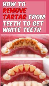 What are some home remedies for removing tooth tartar? How To Remove Tartar From Dentures Arxiusarquitectura