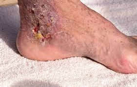 Image result for Cellulitis