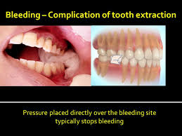 Some painkillers contain adrenaline, and it has the ability to cut small vessels, which are in the gums. Oral And Maxillofacial Surgery Consulting Specialist Ppt Download