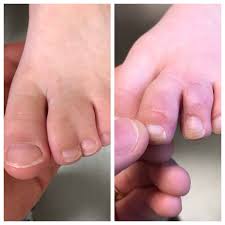 Image result for Syndactyly