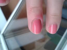 Image result for Akutní zánět nehtového lůžka