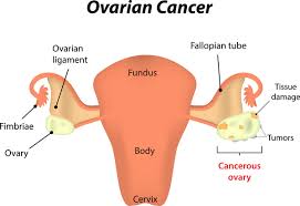 In ovarian cancer care, this includes genetic counselors, medical oncologists, nurse navigators, pathologists, radiation oncologists, radiologists, and surgical oncologists. Ladies Beware Ovarian Cancer Is The Real Deal Camerbeaute