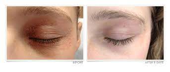 The eyelid dermatitis can be successfully treated if the allergen or the irritant is eliminated. Truelipids Eyelid Dermatitis Care Cheryl Lee Md Sensitive Skin Care