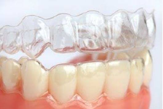 Invisalign Aligners For Crowding Teeth product image