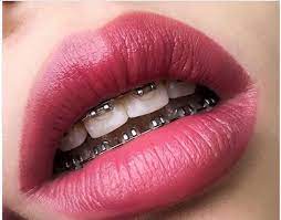 Maybe you would like to learn more about one of these? How Much Do Braces Cost In South Africa 2021 Find It Out Here