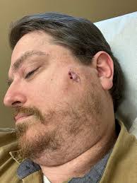 Pheochromocytoma removal and recovery?