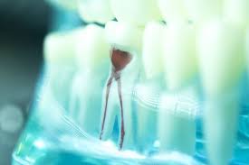 Generally speaking, yes, you can eat after root canal, sometimes even after surgery. Diet Tips After Root Canal Philadelphia Pa What Patients Can Eat