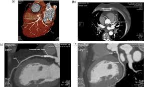 Some specialized detectors can go as deep as 65' (20 m). Evaluation Of Coronary Stents Using Multidetector Ct Sciencedirect